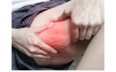 Dermatólogos Privados En Madrid | Madriderma 14 10 puntos sobre el lipedema: la enfermedad que se confunde con obesidad o retención de líquidos