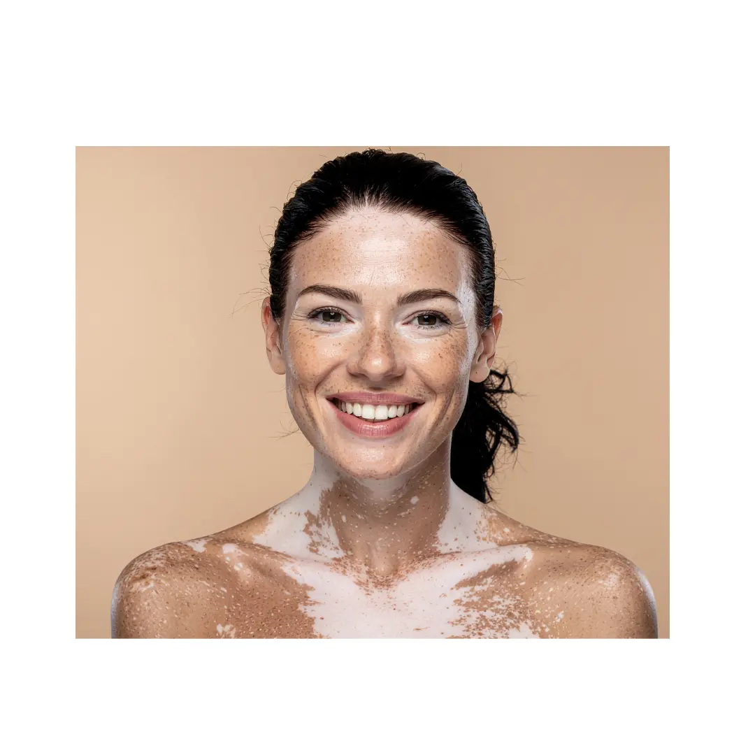 Icomem vitiligo dra fernandez guarino madriderma