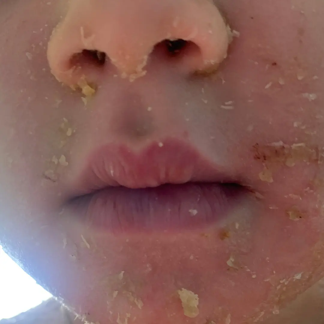 Impetigo en niños en fase de curacion