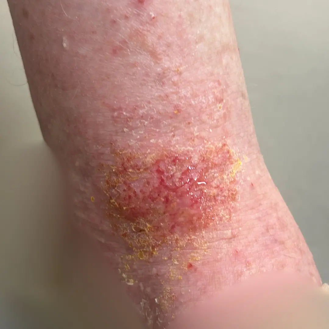 Eccema impetiginizado