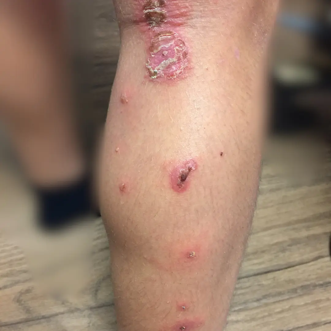 Impetigo por dermatologo
