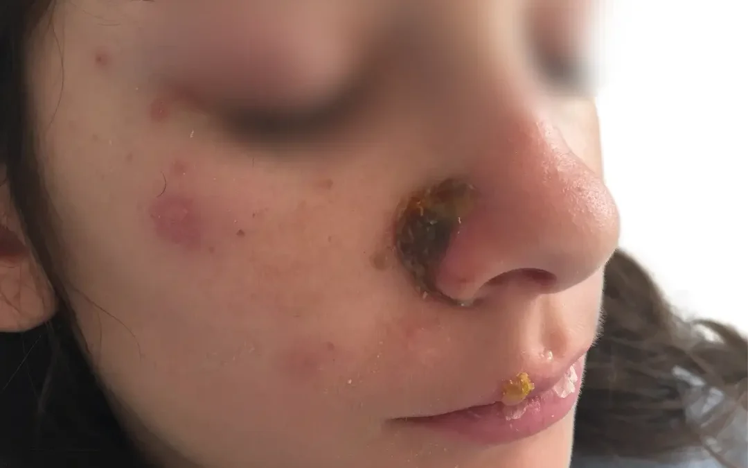 Impetigo en niños por dermatologo