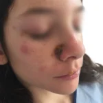 Impetigo en niños por dermatologo